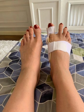 Jennifer's foot with the Pedineo® corrector